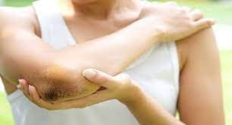 কনুইয়ের কালো দাগ দূর করার ৩ উপায়