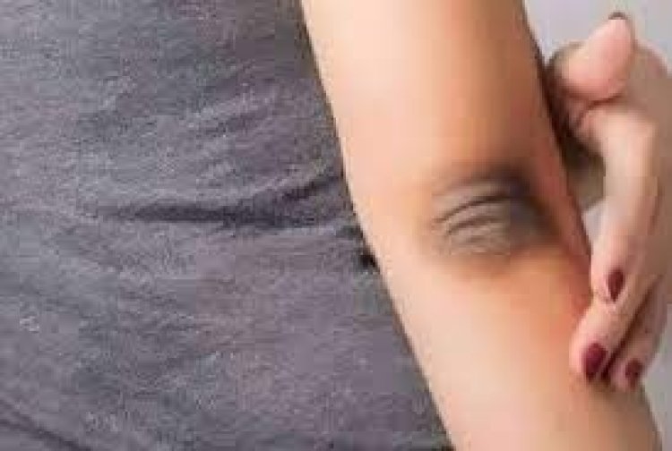 কনুইয়ের কালো দাগ দূর করতে কী করবেন
